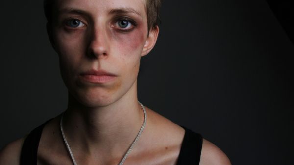 “All women wherever they live in Europe must be protected against all forms of violence” Bruised young woman